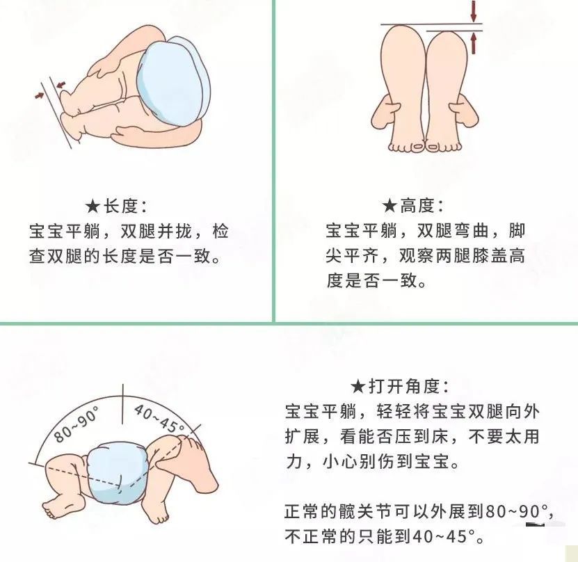 关于三个月宝宝腿纹不对称的探讨