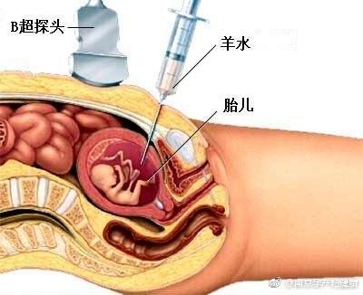 澳门知识专家解析，八个月羊水破后胎儿能保几天？