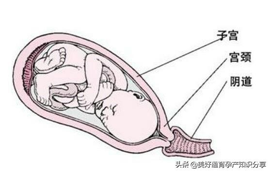 四个月胎盘低置状态的处理与应对策略