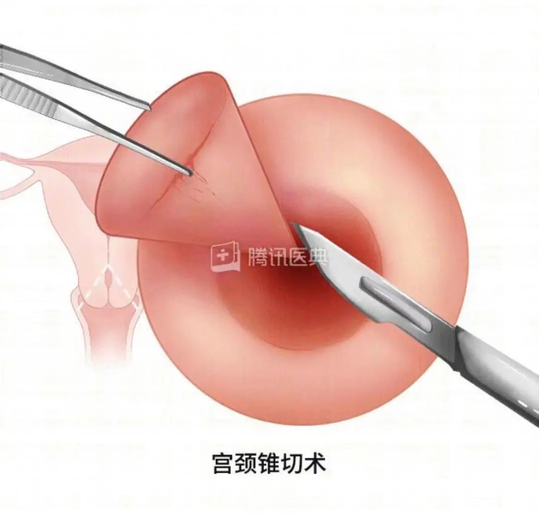 锥切三个月后宫颈图片，恢复与观察